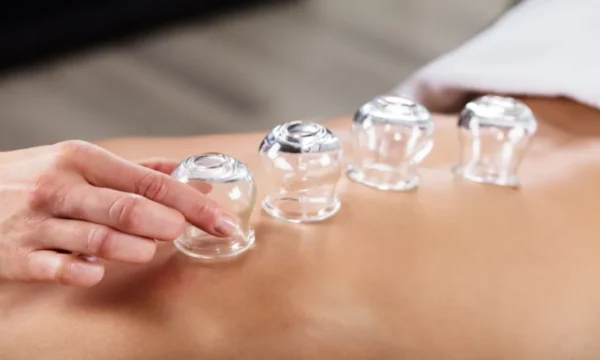 Cupping Therapy